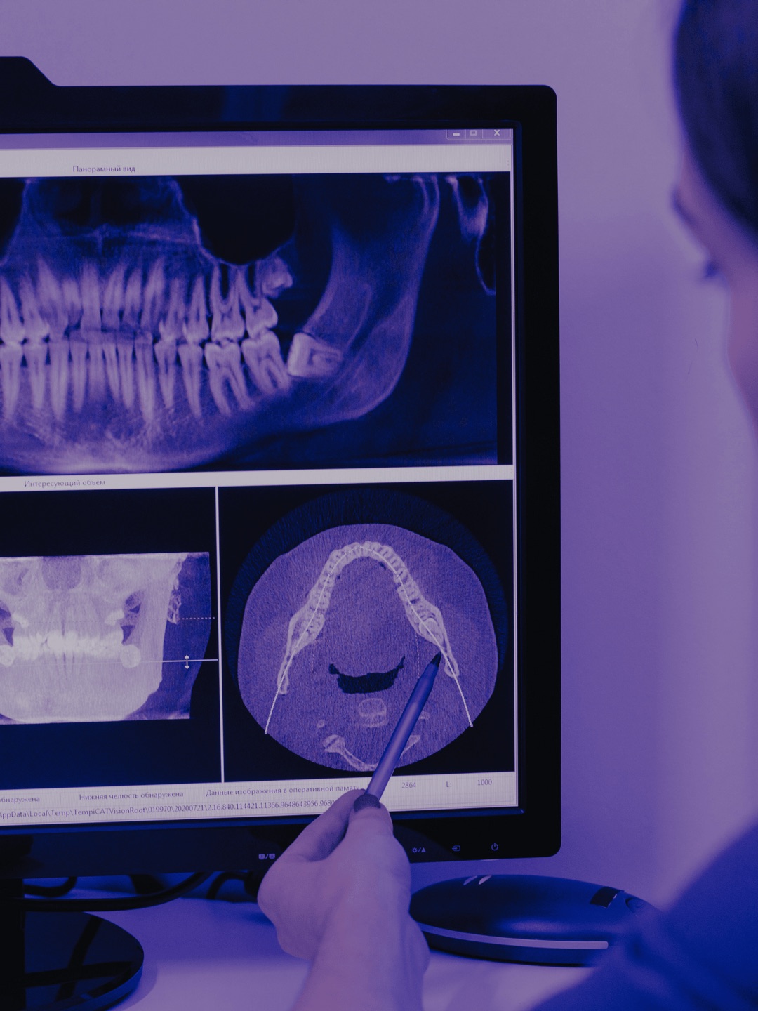 A clinician reviewing a CBCT scan of the jaw and teeth on a monitor